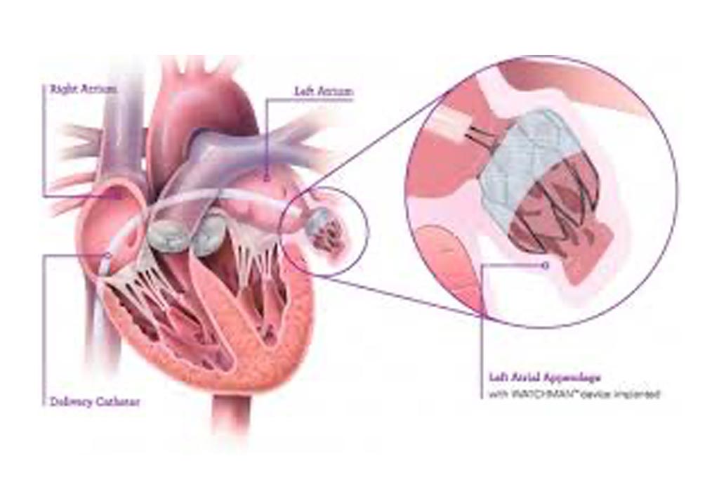 Left Atrial Appendage Closure